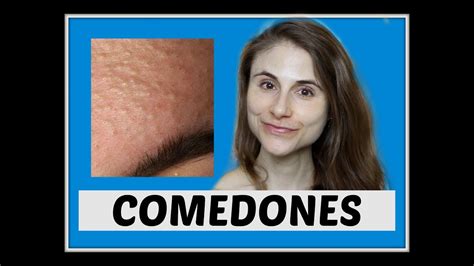 Closed Comedones Qanda With Dermatologist Dr Dray Youtube