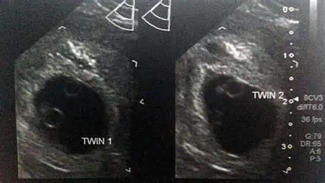 6 weeks pregnant with twins belly pictures symptoms and ultrasound about twins