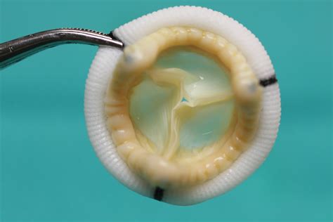 A Bioprosthetic Heart Valve Has Been Fabricated From A Pigs Valve