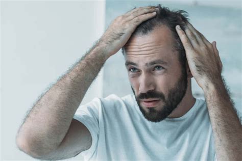 Common Hair Loss Causes In Men Man Of Many