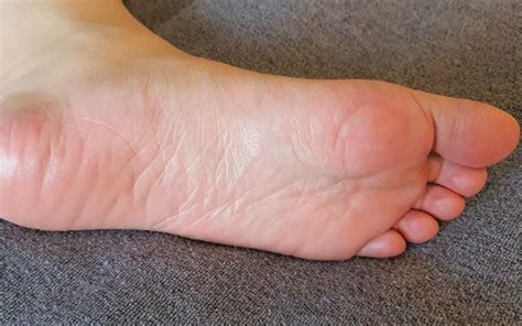 7 Most Common Foot Problems Causes Treatments And Prevention
