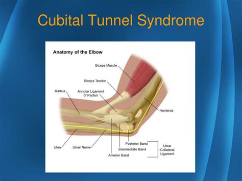 Ppt Musculoskeletal Disorders Cubital Tunnel Syndrome Powerpoint