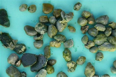Liver Flush Collected Stones On Curezone Image Gallery