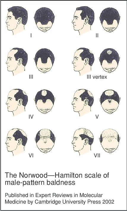 7 Stages Of Male Pattern Baldness Male Balding Patterns 101