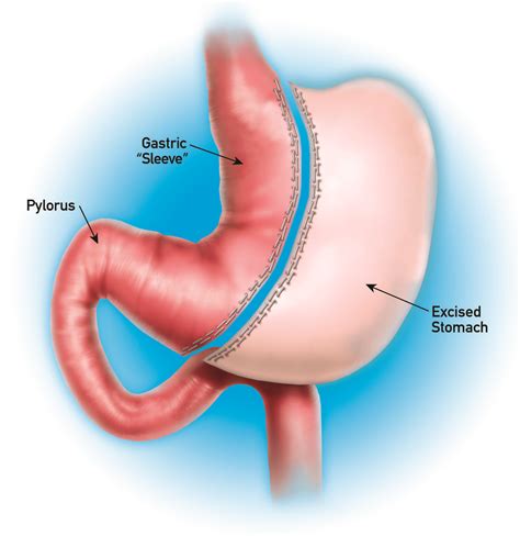 Sleeve Gastrectomy In Plano Dallas Laparoscopic Gastric Sleeve
