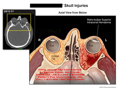 AMICUS Illustration Of Amicus Injury Skull Injuries CT Eye Orbital Fat