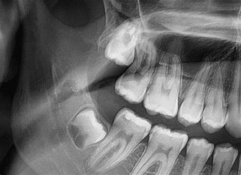 Wisdom Teeth Plano Tx Texas Oral Surgery Group