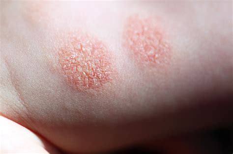 Eczema Nummulare Cause Sintomi E Trattamento Fresh Surgery