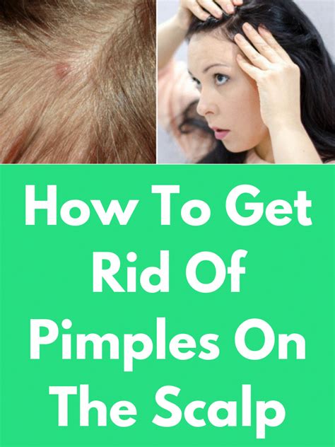 How To Get Rid Of Pimples On The Scalp Pimples Are Common In Any Part