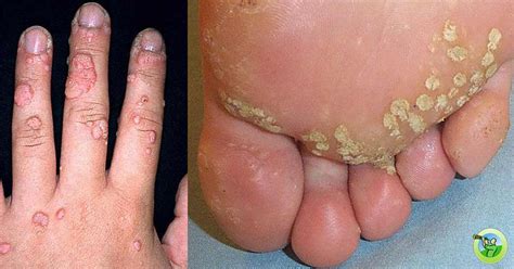 Human Papillomavirus Feet On The Soles Of Translation