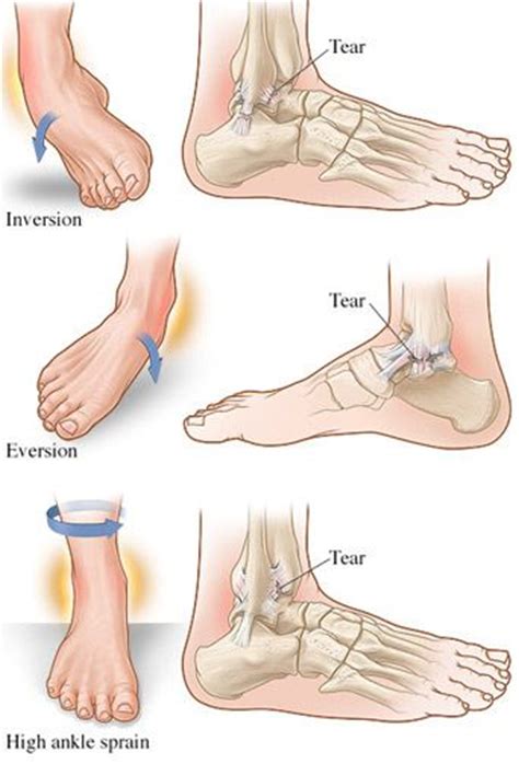 10 Broken Ankle Ideas Broken Ankle Ankle Sprained Ankle
