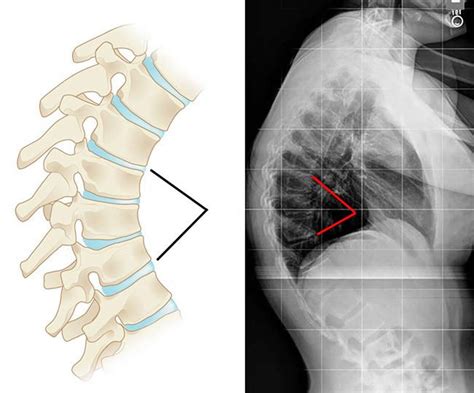 Scheuermann's disease, or scheuermann's kyphosis, is a condition in which the normal roundback in the upper spine is increased and results in a hunchback appearance, but rarely causes back pain. Kyphosis - Causes, Symptoms, Exercises, Surgery, Treatment