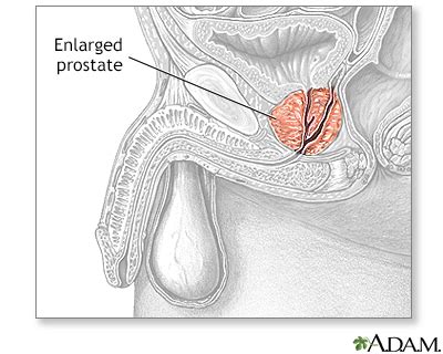Transurethral Resection Of The Prostate