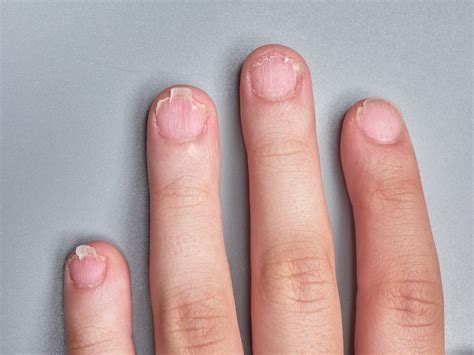 Brittle Nails Causes And Care Guide For Healthier Fingernails