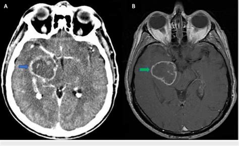 A Ct Brain Axial With Contrast Showing A Right Temporal Lobe Tumor