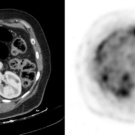 Pulmonary Nodule With Lobulated Margins Figure 6 Benign Granuloma