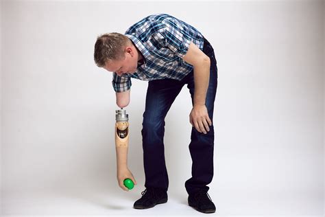 Bionic Arm Prosthetics