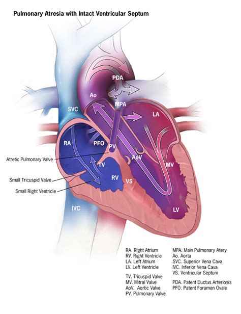 Facts About Pulmonary Atresia Congenital Heart Defects Ncbddd Cdc