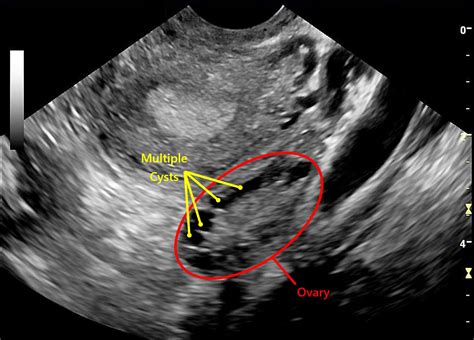 The Pelvic Ultrasound Scan Fertility Test Conception Advice