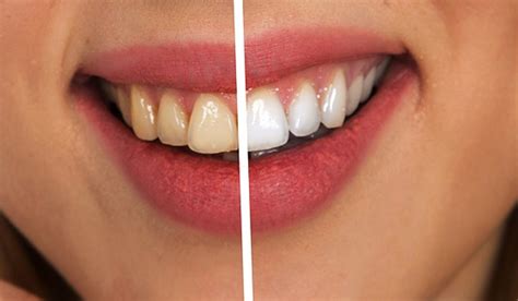 Methods For Transforming Stained Teeth