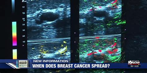 Medical Moment When Does Breast Cancer Spread