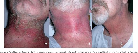 Figure 3 From Management Of Radiation Dermatitis In Patients Receiving