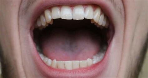 Tiny Bumps On Mouth Roof Red Spots On Roof Of Mouth Health Momma