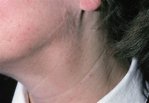 Swollen Glands Lymphadenopathy In Womans Neck Stock Image M200