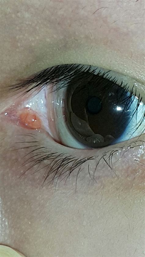 I Have This Small Bump At The Inner Corner Of My Left Eye Is It Cancer