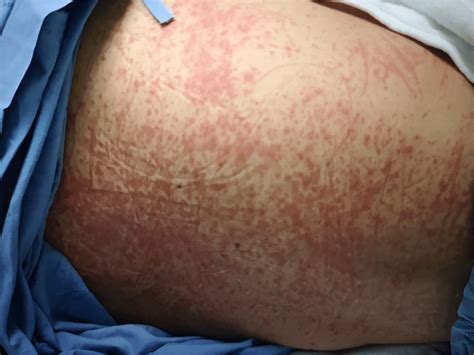 Generalized Maculopapular Rash Throughout The Face Neck And Trunk In
