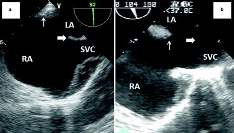 Echocardiography In The Management Of Atrial Septal Defect Asd And