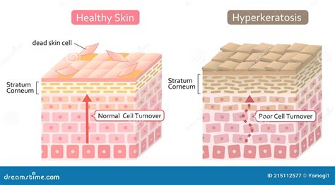 Diagram Of Skin Cell Turnover And Thickening Of The Stratum Corneum