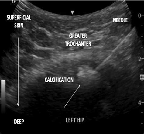 Gluteus Medius Tendon Ultrasound