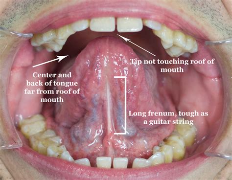 I Finally Figured Out Proper Tongue Posture — Jaw Hacks