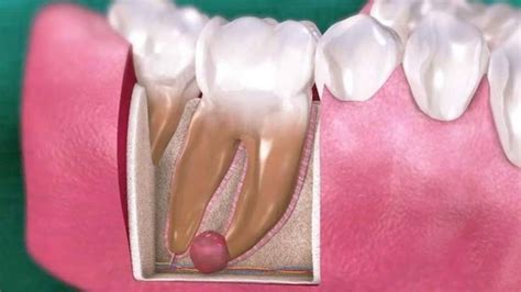 Diş Kisti Nedir Diş Kisti Belirtileri ve Dental Kist Tedavisi