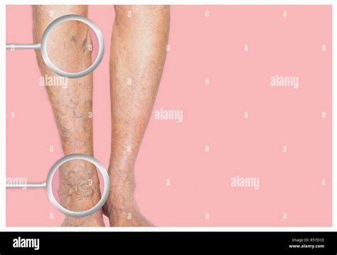 Varicose Veins On A Female Legs Stock Photo Alamy