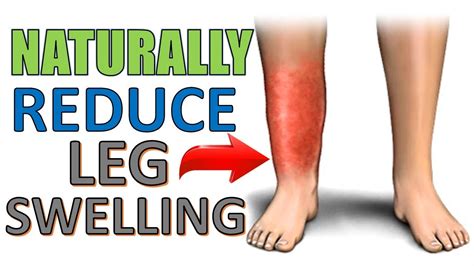 How To Stop Leg Swelling Whilst Running Exercising And Gym Work Youtube