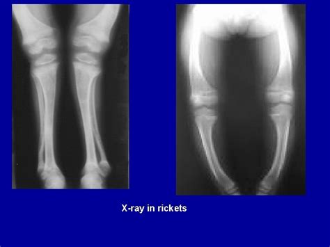 Rickets Rickets Definition Failure Of Mineralisation Of The