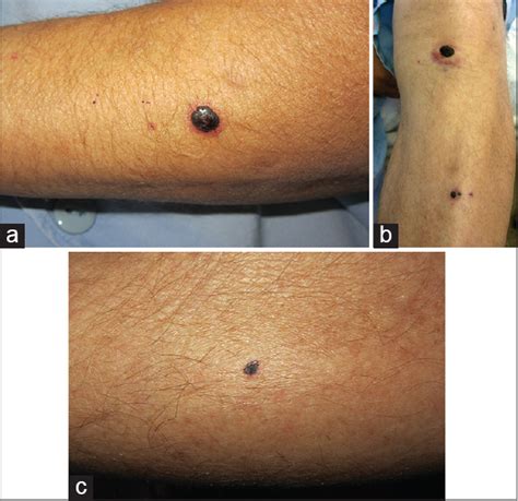 Bullous Hemorrhagic Dermatosis Probably Associated With Enoxaparin