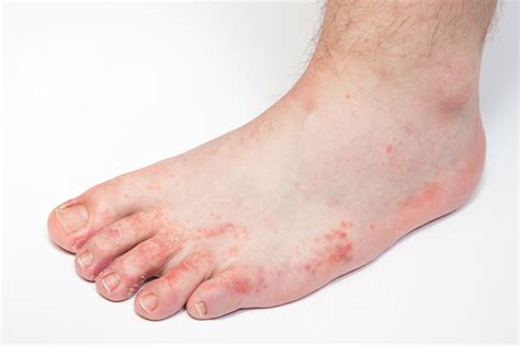 Tinea Pedisathletes Footsymptomcausesmedication And Prevention How