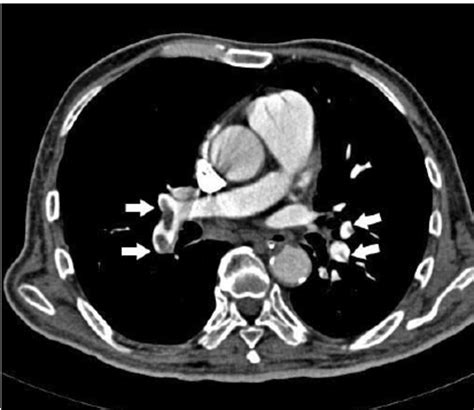 Axial Ct Image Shows Emboli In Both The Lower Lobar