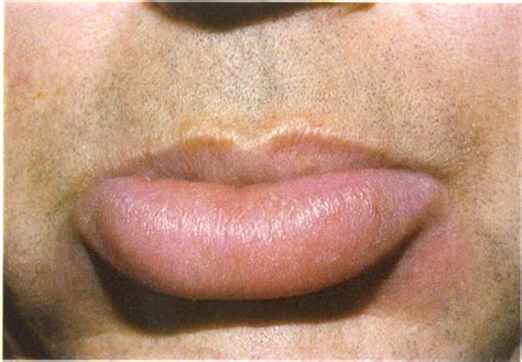 Dermatology For Dentists And Dental Students Lips