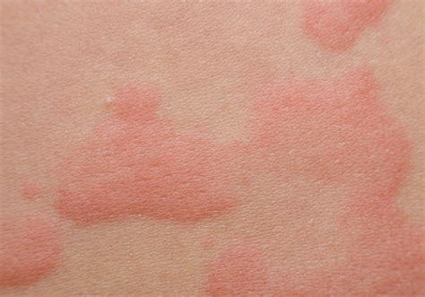 What Are Hives Symptoms Of Hives Lloydspharmacy