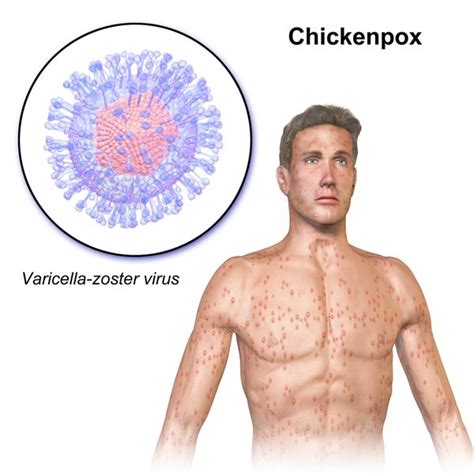 Chickenpox Shingles Causes Mode Of Transmission And Treatment