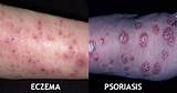 Pictures of Weeping Eczema Treatment