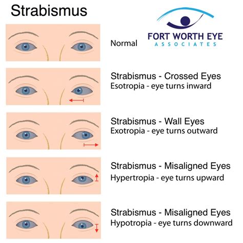 Strabismus Surgery Types Fort Worth Eye Associates