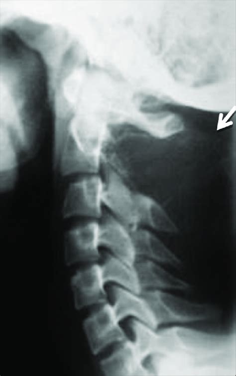 Aneurysmal Bone Cyst Of C2 Lateral Radiograph Of The Cervical Spine