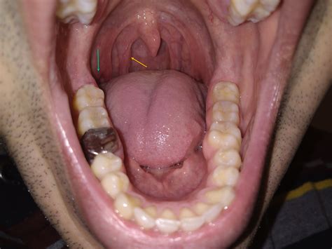 Chronic Sore Throat From Weeks Oladoc Hot Sex Picture