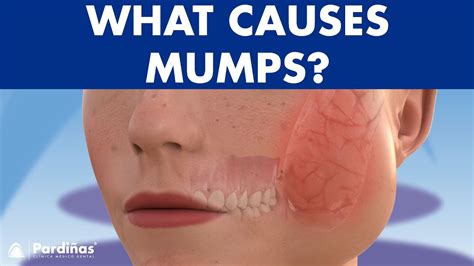 Mumps Parotitis And Other Salivary Glands Conditions Sialadenitis