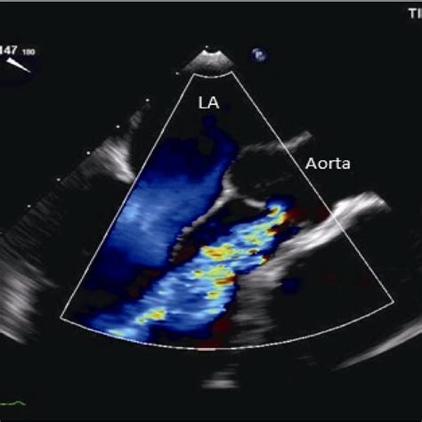 Aortic Regurgitation Transesophageal Echocardiogram Midesophageal